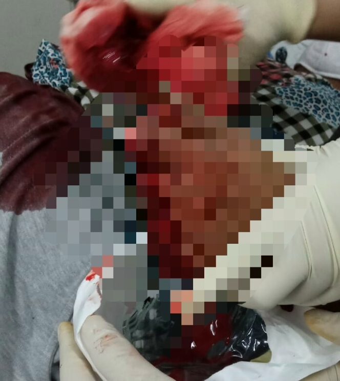 
					Ket. Foto : 
Jari-jari tangan kiri Erdina Boru Sihombing (54) warga Jalan AR Hakim Gang Rahayu II, Kecamatan Medan Denai, putus dibacok mendapat pertolongan petugas medis, Jumat (1/5/2020). Pelaku berhasil merampas tas korban yang berisikan uang tunai kurang lebih Rp 4 juta dan 1 unit hp merk nokia warna hitam. (red)
