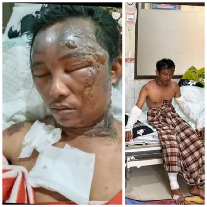 
					Ket foto: Kondisi korban kecelakaan kerja Lingga (29) warga Desa Pematang Jaya, Indragiri Hulu, Riau yang masih terbaring di RSUD Indrasari Rengat.